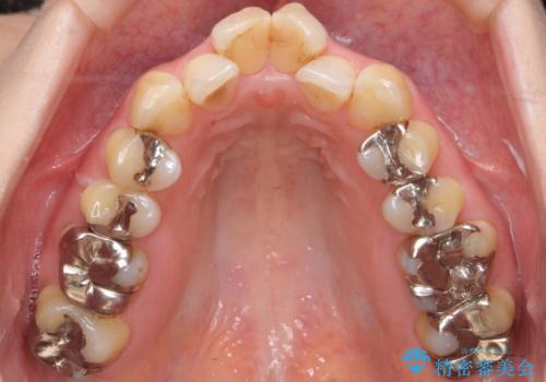 40代の矯正 出っ歯、歯のがたがたの治療前