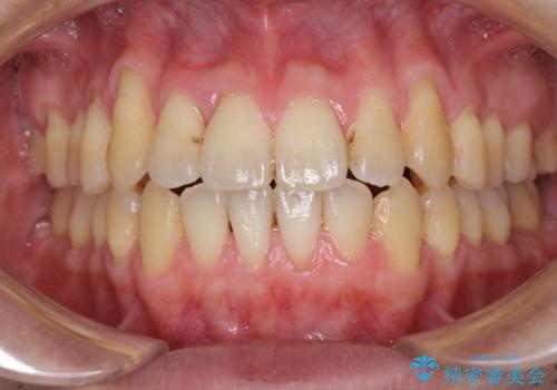 矯正歯科治療と前歯の歯肉移植術の治療中
