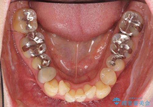 40代の矯正　出っ歯、歯のがたがたの治療前