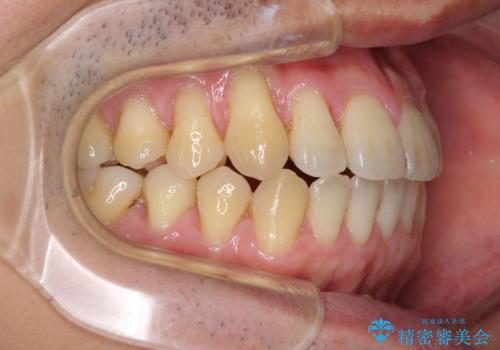 矯正歯科治療と前歯の歯肉移植術の治療中