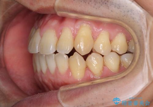 矯正歯科治療と前歯の歯肉移植術の治療中