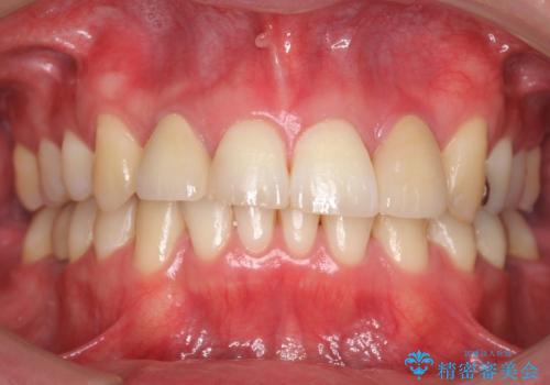八重歯の矯正+歯のないところにインプラントの治療後