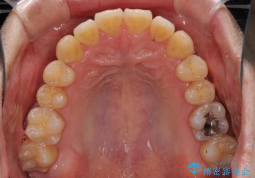 矯正歯科治療と前歯の歯肉移植術の治療中