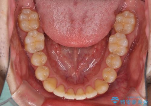 矯正歯科治療と前歯の歯肉移植術の治療中