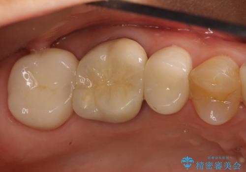 適合が悪いかぶせ物と詰め物の再治療の治療後