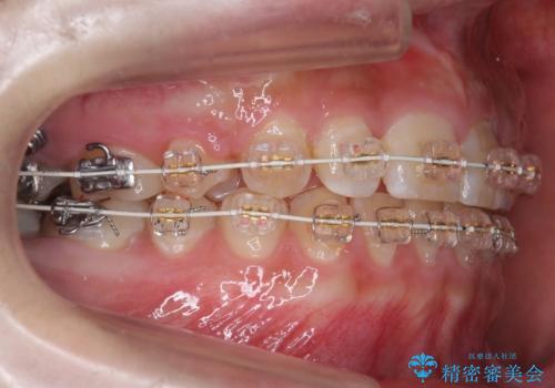 前歯のがたつき 過蓋咬合の治療中