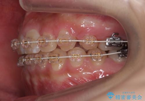 前歯のがたつき 過蓋咬合の治療中