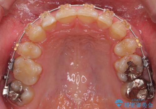 前歯のがたつき 過蓋咬合の治療中