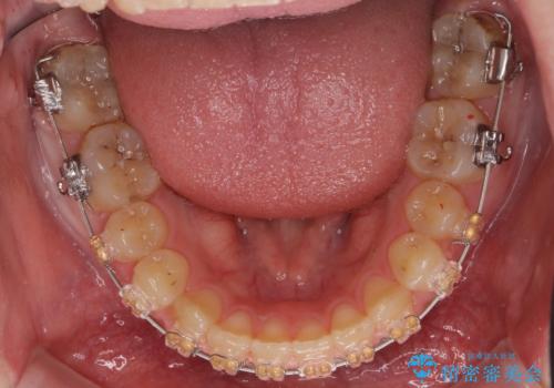 前歯のがたつき 過蓋咬合の治療中