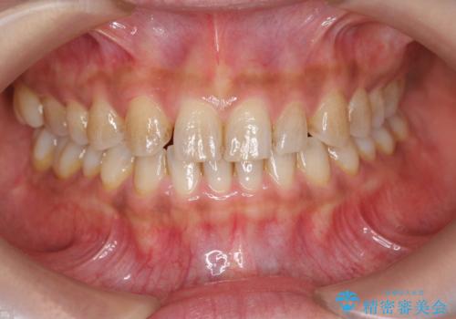 ホワイトニングで白い歯に 1日でできますの症例 治療前