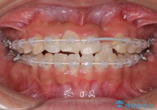 美容歯科でも断られた 著しい前歯のクロスバイトをワイヤー矯正で改善の治療中