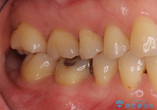 銀歯を白く セラミックインレーにの治療前