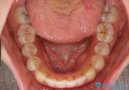 上下の前歯のがたつき 歯を抜かずに矯正の治療後