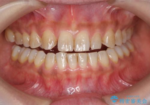 ホワイトニングで白い歯に 1日でできますの治療前