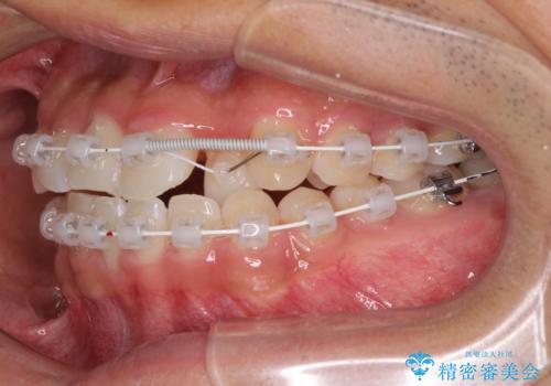 美容歯科でも断られた 著しい前歯のクロスバイトをワイヤー矯正で改善の治療中