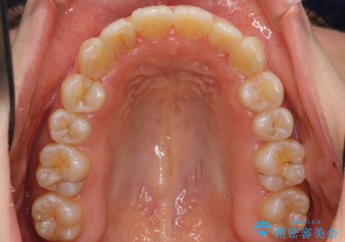 上下の前歯のがたつき 歯を抜かずに矯正の治療後