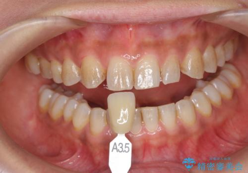 ホワイトニングで白い歯に 1日でできますの治療前