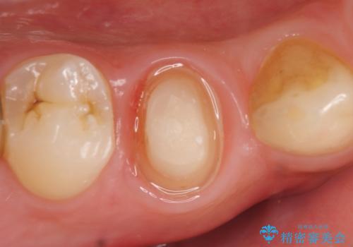 オールセラミッククラウン　咬むと痛む歯の根管治療～補綴の治療中