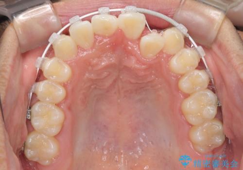 美容歯科でも断られた 著しい前歯のクロスバイトをワイヤー矯正で改善の治療中
