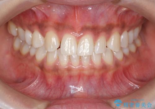 ホワイトニングで白い歯に 1日でできますの症例 治療後