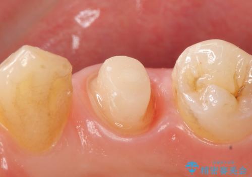 オールセラミッククラウン 咬むと痛む歯の根管治療~補綴の治療中