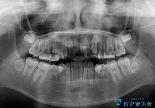 乳歯が残っている 目立たない装置での抜歯矯正の治療前