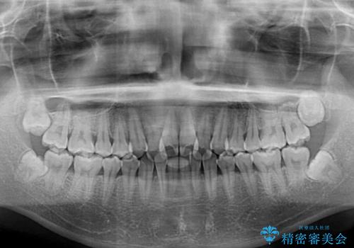 前歯のクロスバイト インビザラインによる矯正治療の治療前