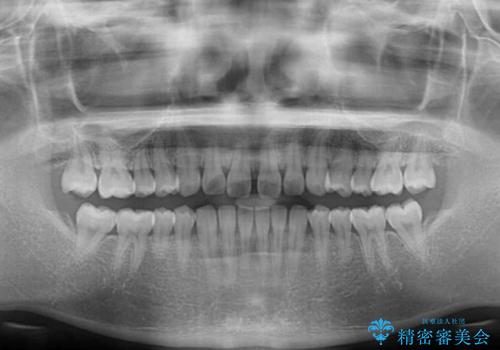 インビザラインによるすきっ歯の改善の治療前