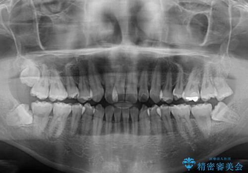 矯正歯科治療と前歯の歯肉移植術の治療前