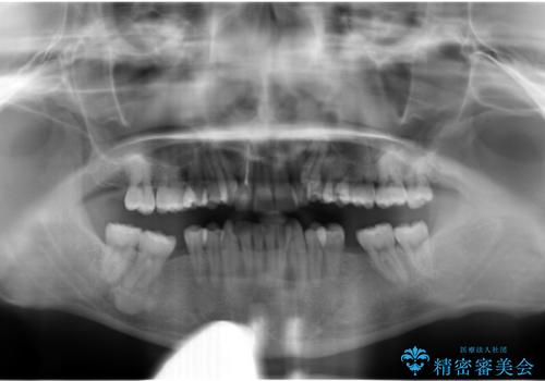 八重歯の矯正+歯のないところにインプラントの治療前