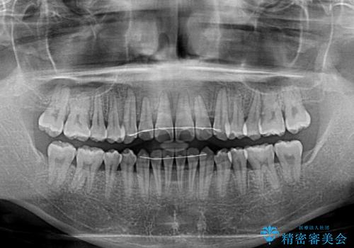 前歯のクロスバイト インビザラインによる矯正治療の治療後