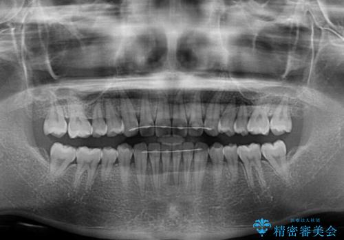 インビザラインによるすきっ歯の改善の治療後
