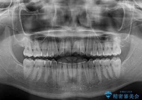 美容歯科でも断られた 著しい前歯のクロスバイトをワイヤー矯正で改善の治療後