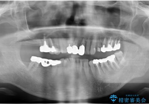 親知らずの移植 70代男性の治療前