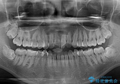 留学前に矯正治療 目立たないワイヤー装置でのスピード矯正の治療前