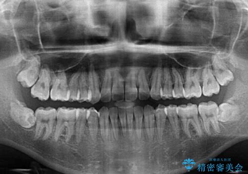 留学前に矯正治療 目立たないワイヤー装置でのスピード矯正の治療後