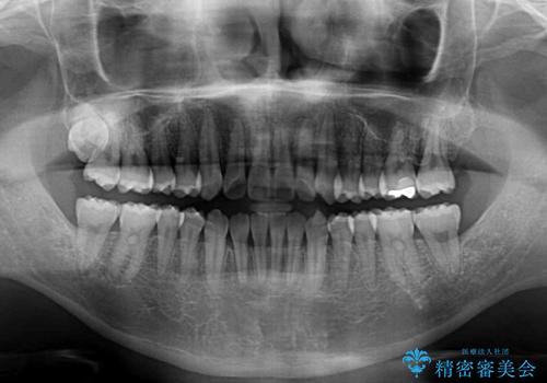 矯正歯科治療と前歯の歯肉移植術の治療後