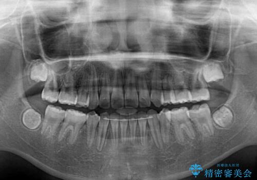 乳歯が残っている 目立たない装置での抜歯矯正の治療後