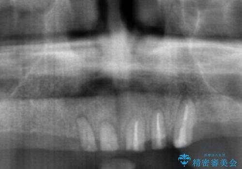 [インプラントオーバーデンチャー] インプラントで奥歯を支える部分床義歯の治療前