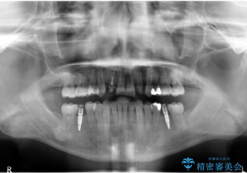 八重歯の矯正+歯のないところにインプラントの治療後