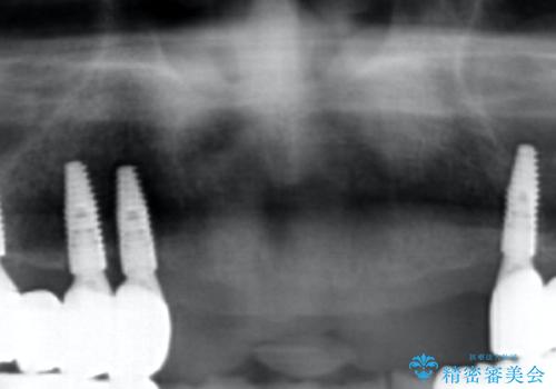 [インプラントオーバーデンチャー] インプラントで奥歯を支える部分床義歯の治療後