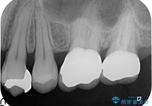目立つ金歯を自然な色のオールセラミックへの治療後