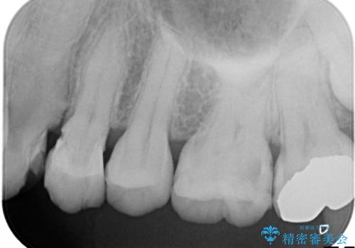 他院による虫歯治療(ドックスベストセメント)の再治療の治療前