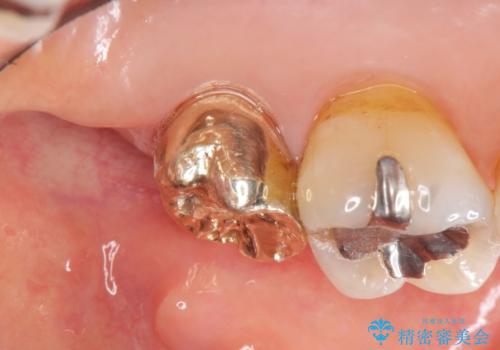 歯周外科で整備する安定したクラウン環境の症例 治療後