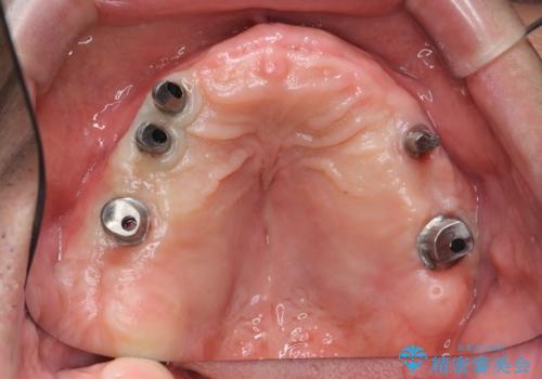 [インプラントオーバーデンチャー] インプラントで奥歯を支える部分床義歯の治療中