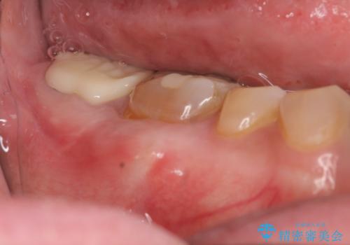 歯ぎしりによる異常に低い歯冠高径 　歯周外科による解決の症例 治療後