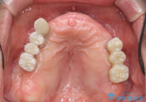 [インプラントオーバーデンチャー] インプラントで奥歯を支える部分床義歯の治療中
