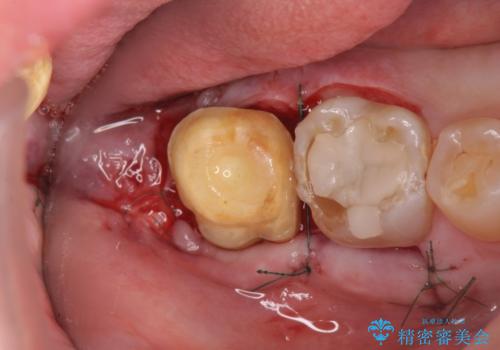 歯ぎしりによる異常に低い歯冠高径 　歯周外科による解決の治療中