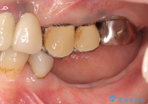 インプラントで咬合機能を取り戻すの治療前