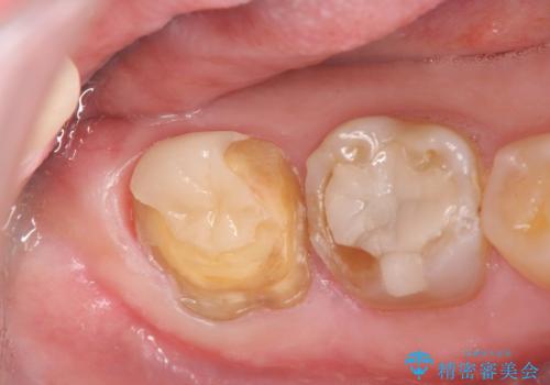 歯ぎしりによる異常に低い歯冠高径 　歯周外科による解決の治療中
